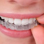 Clear Aligners for Gap teeth Correction in Coimbatore